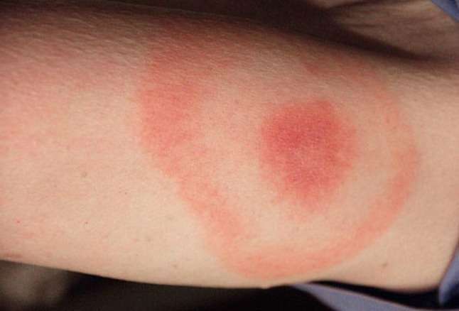 Bulls Eye Rash from CDC